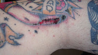 What Causes A Tattoo to Get Infected