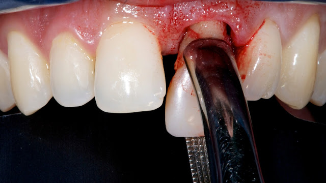 Tooth Extraction And Healing All You Should Know