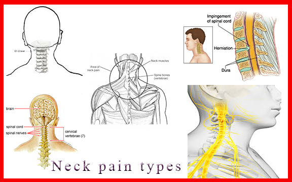 Neck pain types ~ How to fix back pain