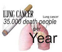 Lung cancer metastasis to bone