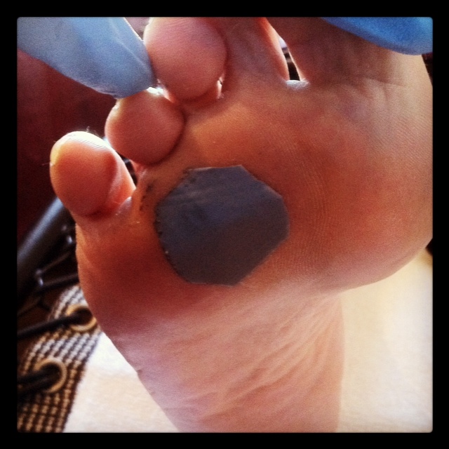 wart on foot removal duct tape)