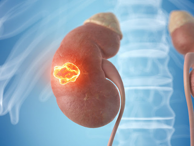 Kidney Cancer