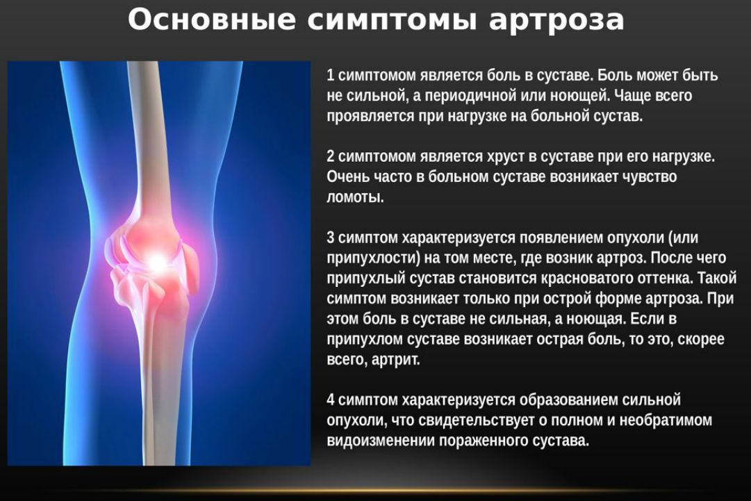 Болезнь суставов у взрослых. Сустав при остеоартрозе. Артроз коленного сустава. Остеоартроза коленного сустава.