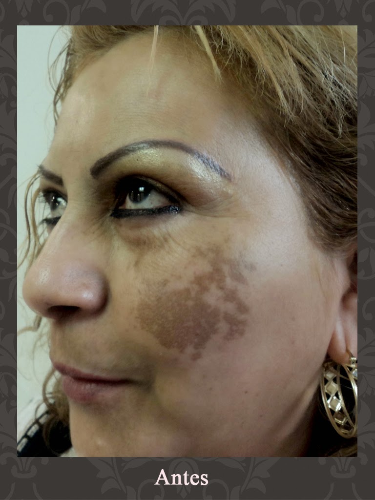 El Melasma, A Primera Hora