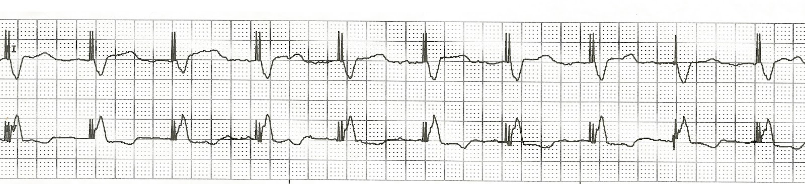 EKG Rhythm Strip Quiz 72