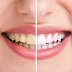 Λεύκανση δοντιών: Πότε είναι ασφαλής;