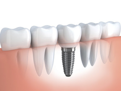 Quy trình làm răng Implant tại nha khoa KIM
