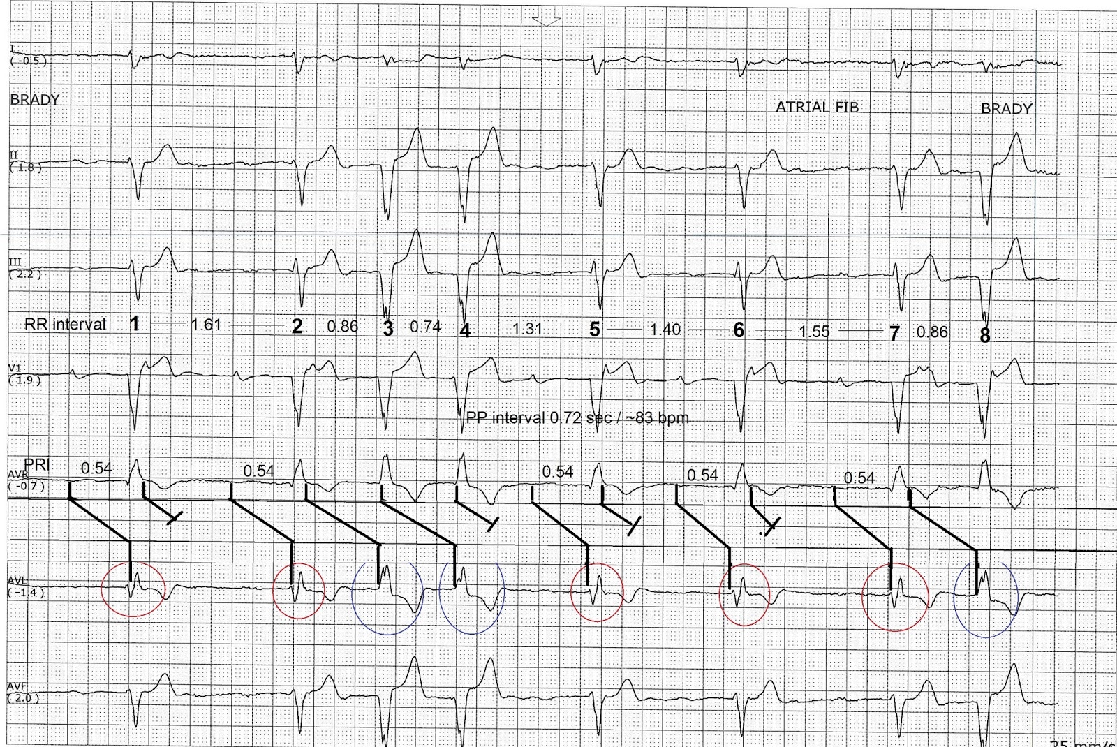 Схема ритма. Интервал RR на ЭКГ. Лестничная диаграмма ЭКГ. Отведения ЭКГ по Льюису. Интервал r-r.