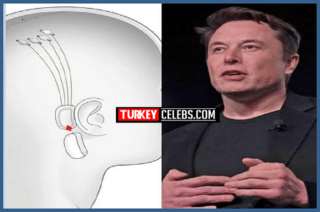 Neuralink chip allows streaming music directly to your brain 2020 Neuralink ,Elon Musk, Neuralink stock