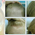 Say Goodbye to Hair Loss Forever By Using These 2 Ingredient Daily
