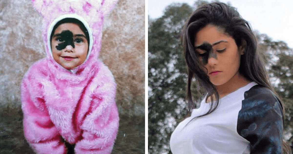 24-Year-Old Girl Decided Not To Remove Her Rare Birthmark Despite What People Told Her