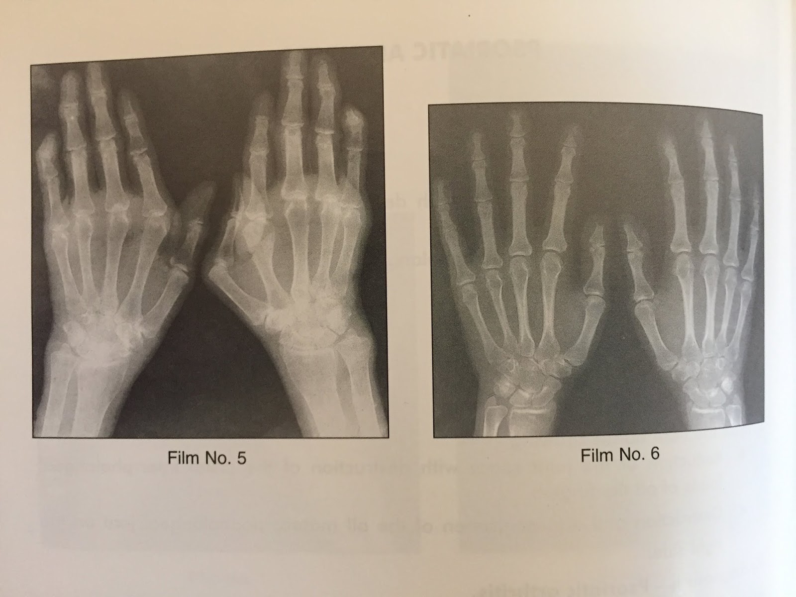 XRAYS OF PSORIATIC ARTHRITIS