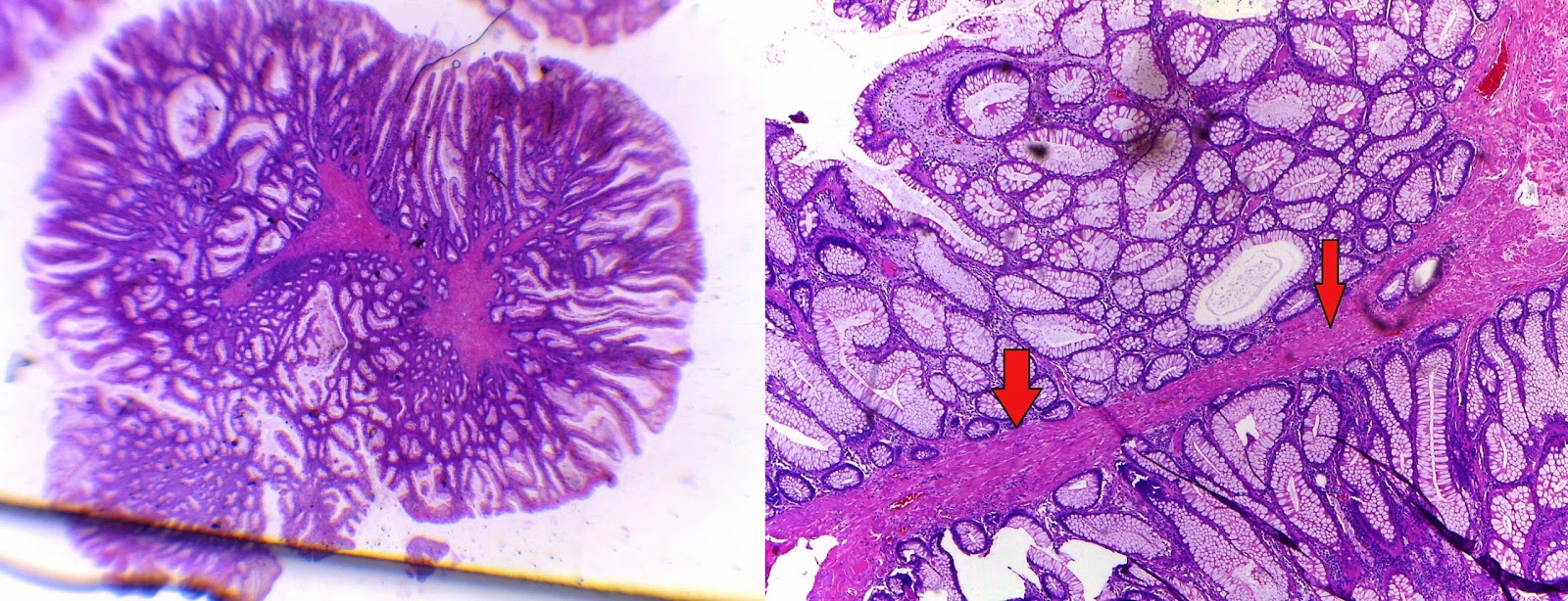 Arborizing Polyps GASTROINTESTINAL AND LIVER HISTOLOGY PATHOLOGY ATLAS: COLON ...