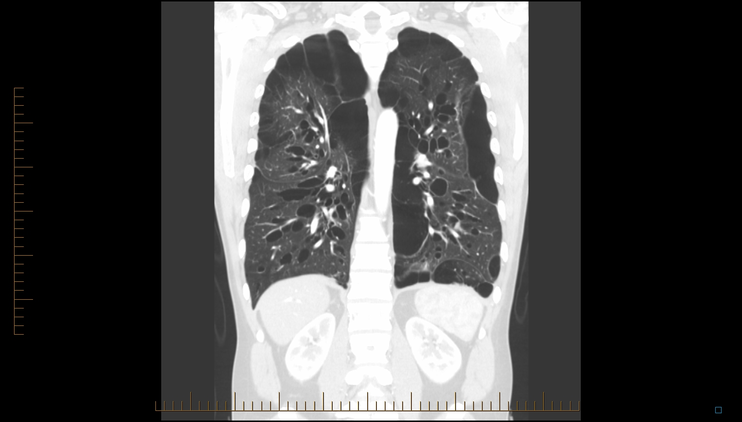 Radiology Cases Idiopathic Bullous Emphysema (Vanishing Lung Syndrome)