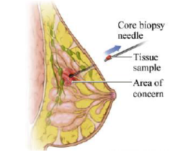 biopsy Core of breast needle