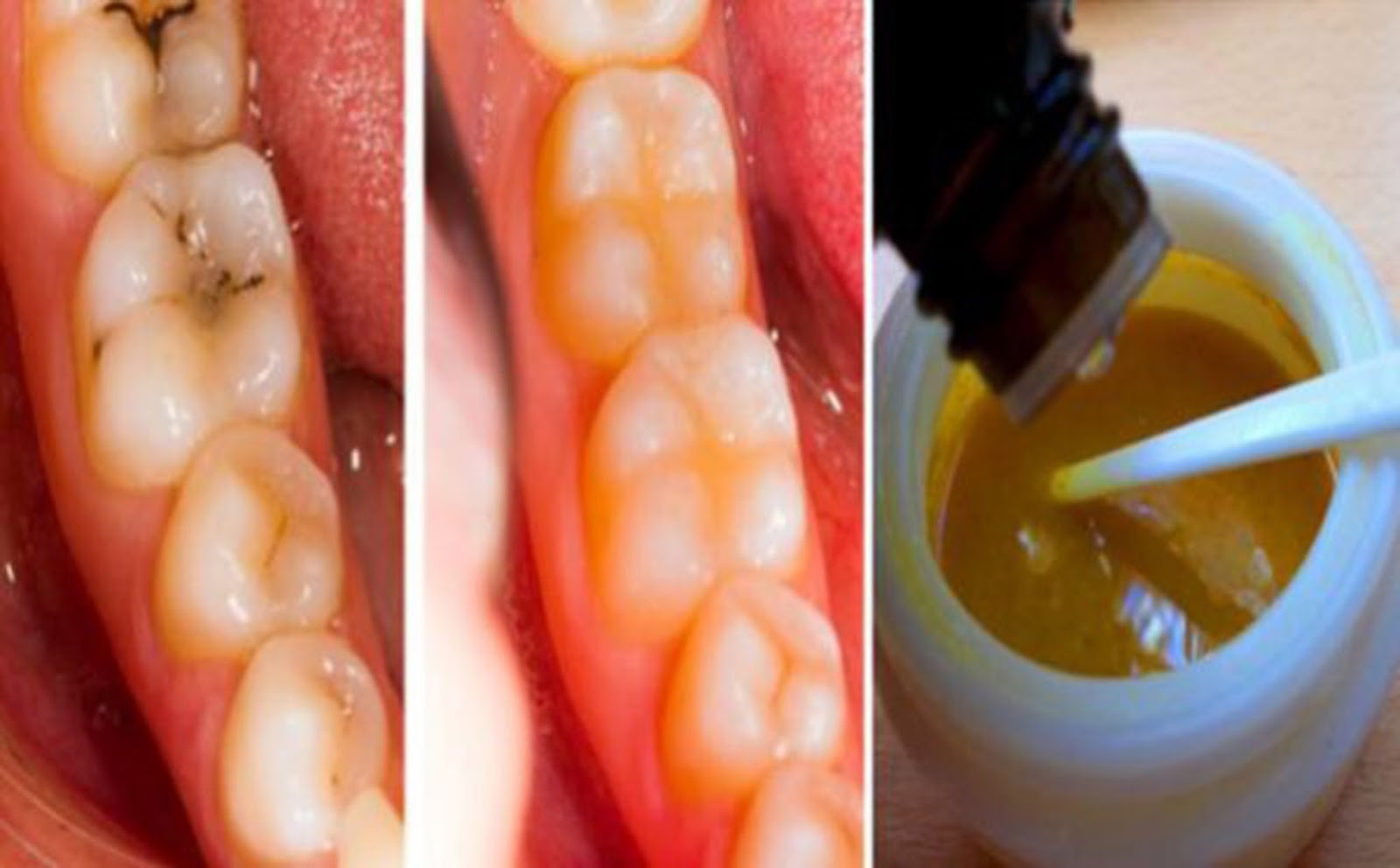 Reverse Cavities Naturally And Heal Tooth Decay With This Powerful