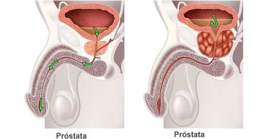 Prostatită cronică doxazosină