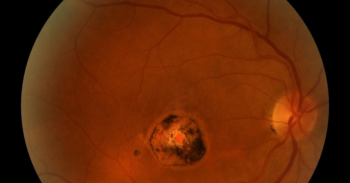 Sonoran Desert Eye Center CHORIORETINAL SCAR