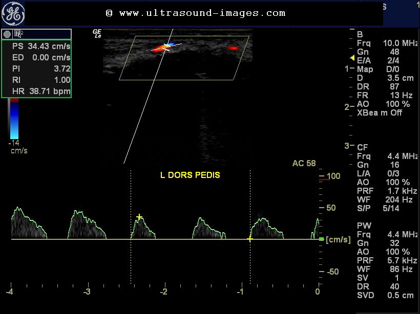 Ultrasound Imaging Doppler Study Severe Arterial Stenosis In Leg