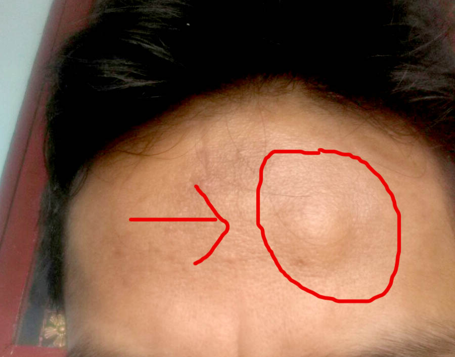 Apa Itu Benjolan Lipoma Dan Bagaimana Menyembuhkannya Sebuah Pengalaman Bag 1 Rahasia Hidup Sukses Bebas Hutang Bahagia Kaya Sejahtera