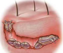 Τί είναι η ψώρα