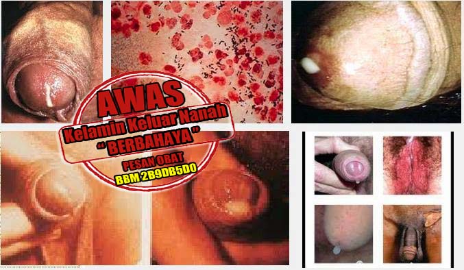 Solusi Pengobatan Kencing Nanah Gonore Pada Wanita Solusi Pengobatan Kencing Nanah Gonore Pada Wanita