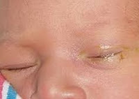 Bebeklerin Gözlerindeki Çapak Nasıl Temizlenir