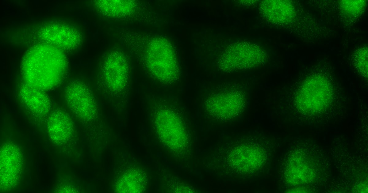 Anticorpos anti SSA (Ro) e anti
