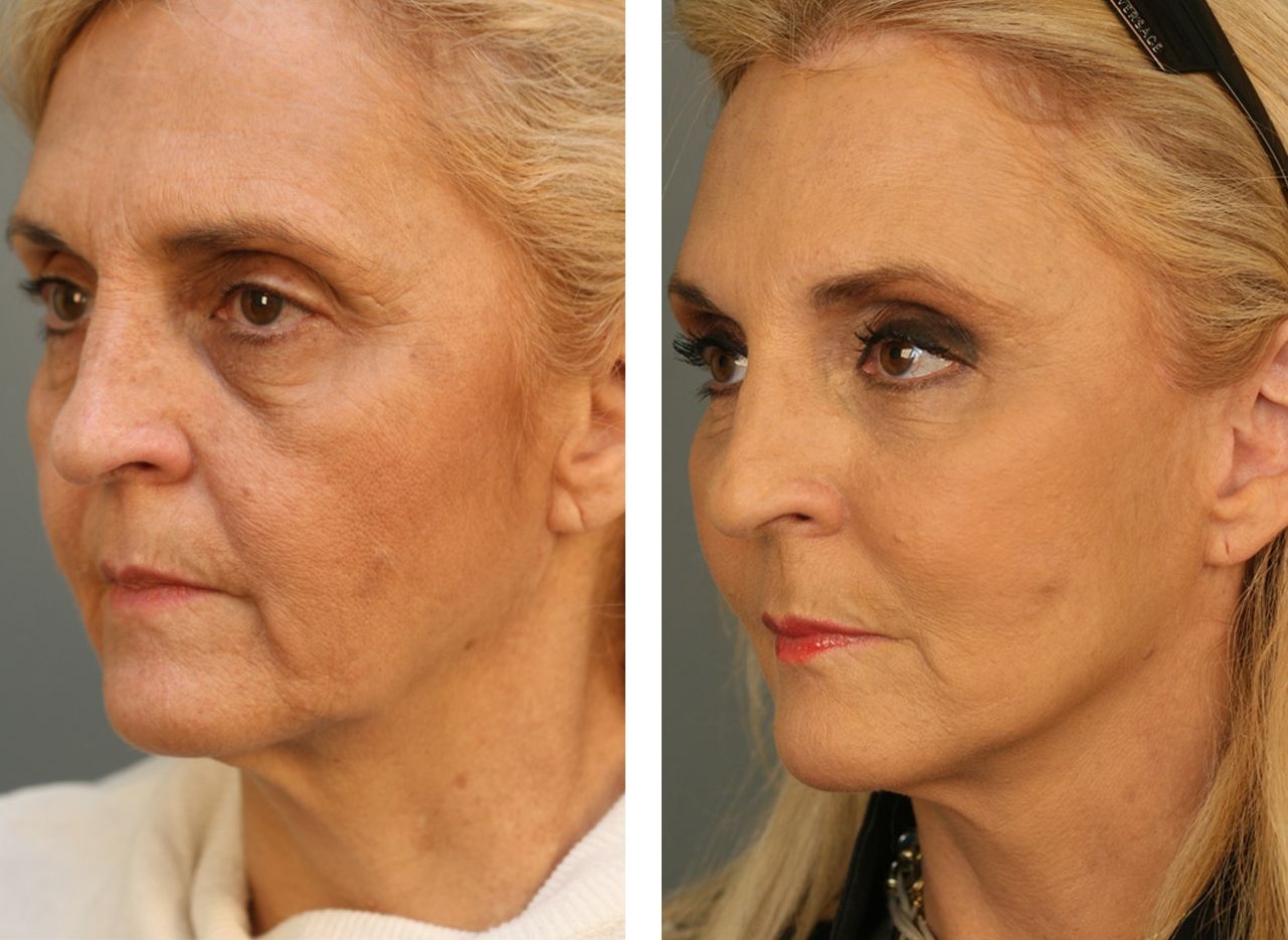 Facial Gymnastics Solutions For Reshaping And Improving Your Face Look