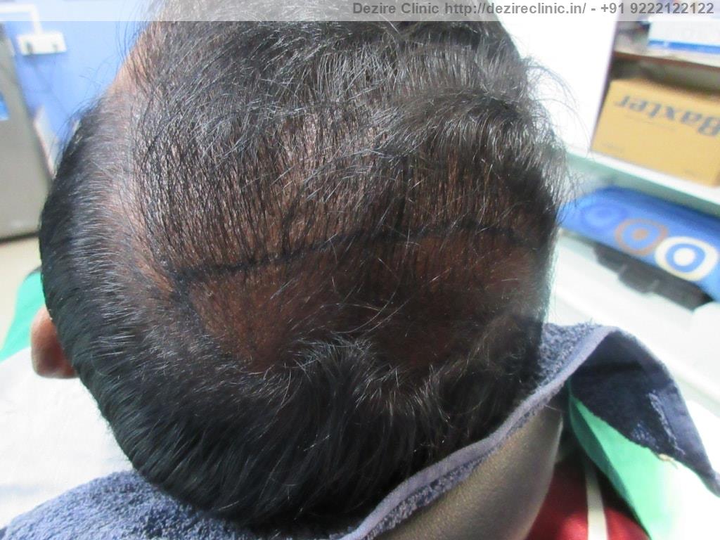 transplant hair dezire clinic pune