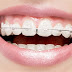 Niềng răng bằng mắc cài sứ là gì?