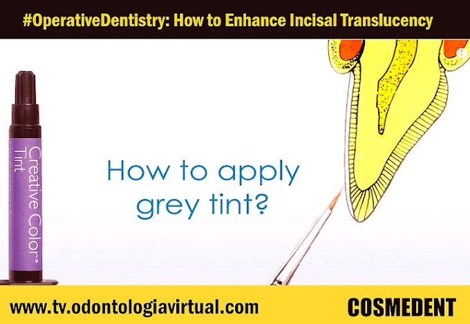 COMPOSITE RESTORATION: How to Enhance Incisal Translucency