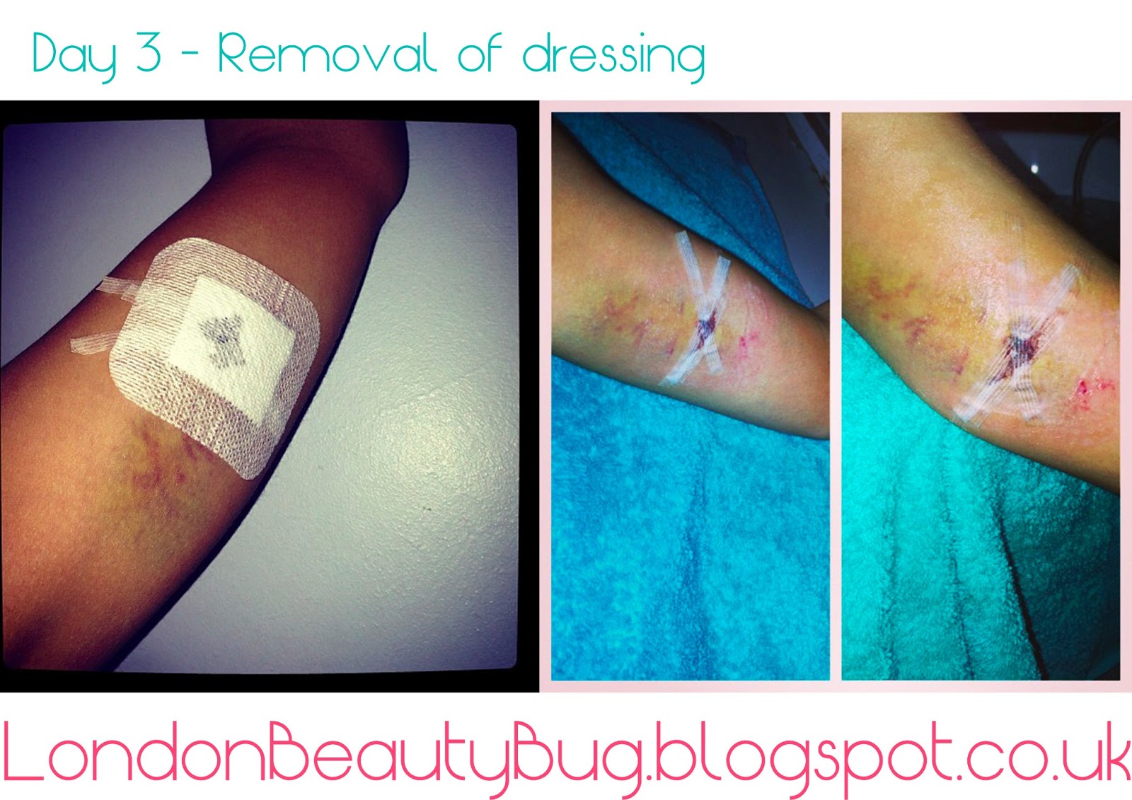 My Experience With Nexplanon Gina Faria Beauty, Fashion, Makeup