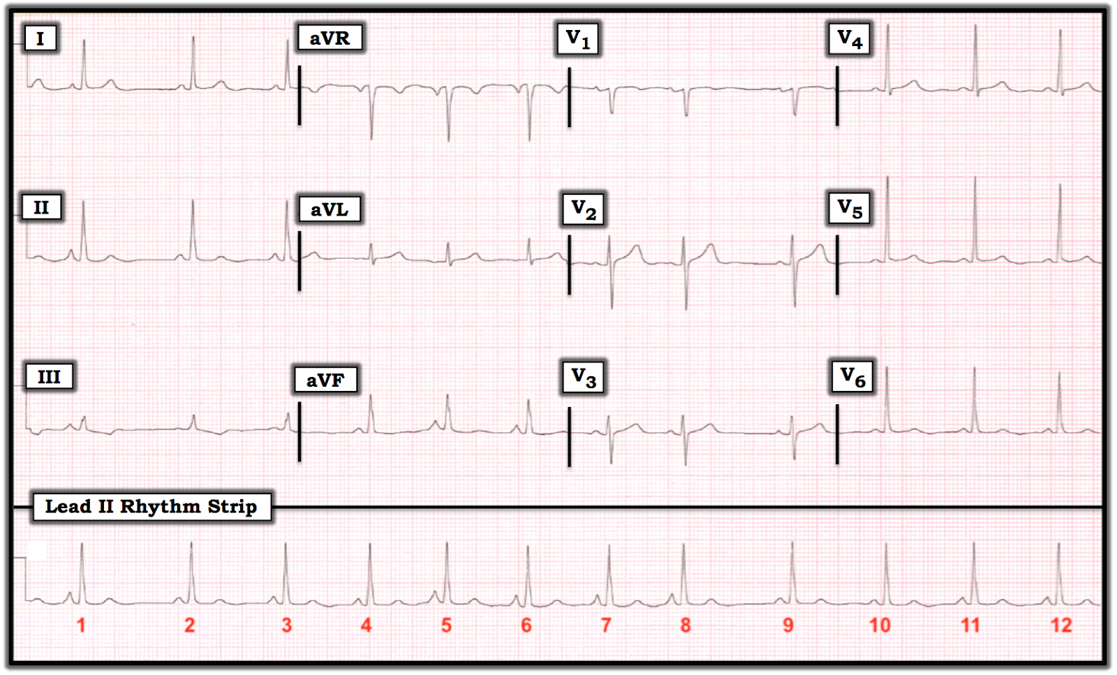 Ecg Interpretation Ecg Blog 155 Arrhythmia Pacs Wandering