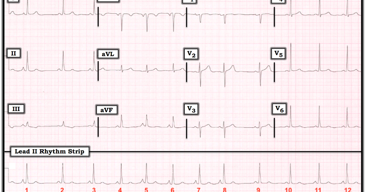 ECG Interpretation ECG Blog 155 (PACs Wandering MAT )