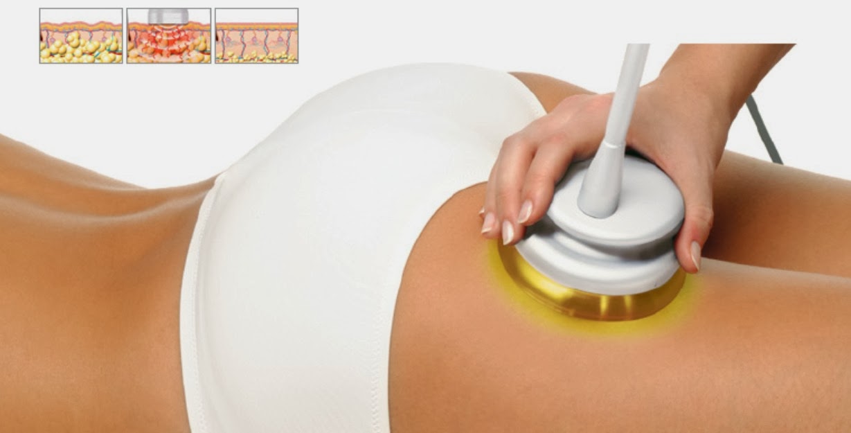 ¿Es seguro perder grasa con radiofrecuencia?