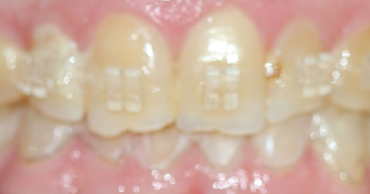 James R. Waters, DDS, MSD, PA Reshaping and polishing edges of teeth after braces