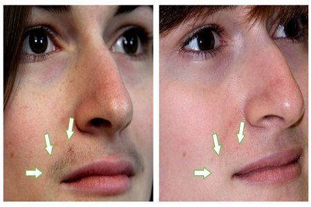 spots permanently facial Diminish Sexy girls in the city