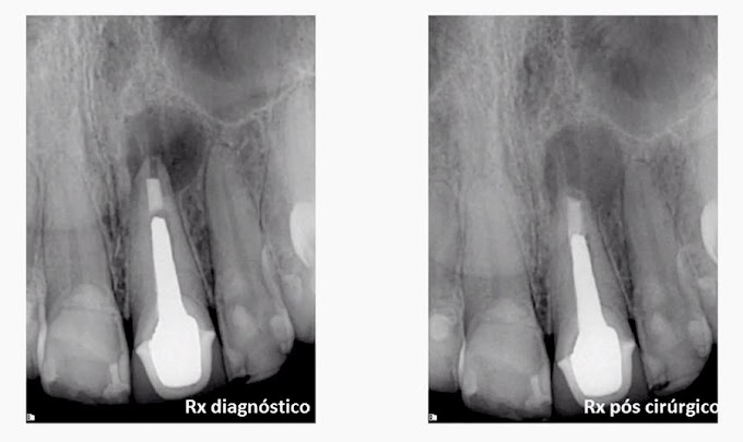 ENDODONTIA: Retroinstrumentação ultrassônica utilizando Endogel como substância química auxiliar - dente 21