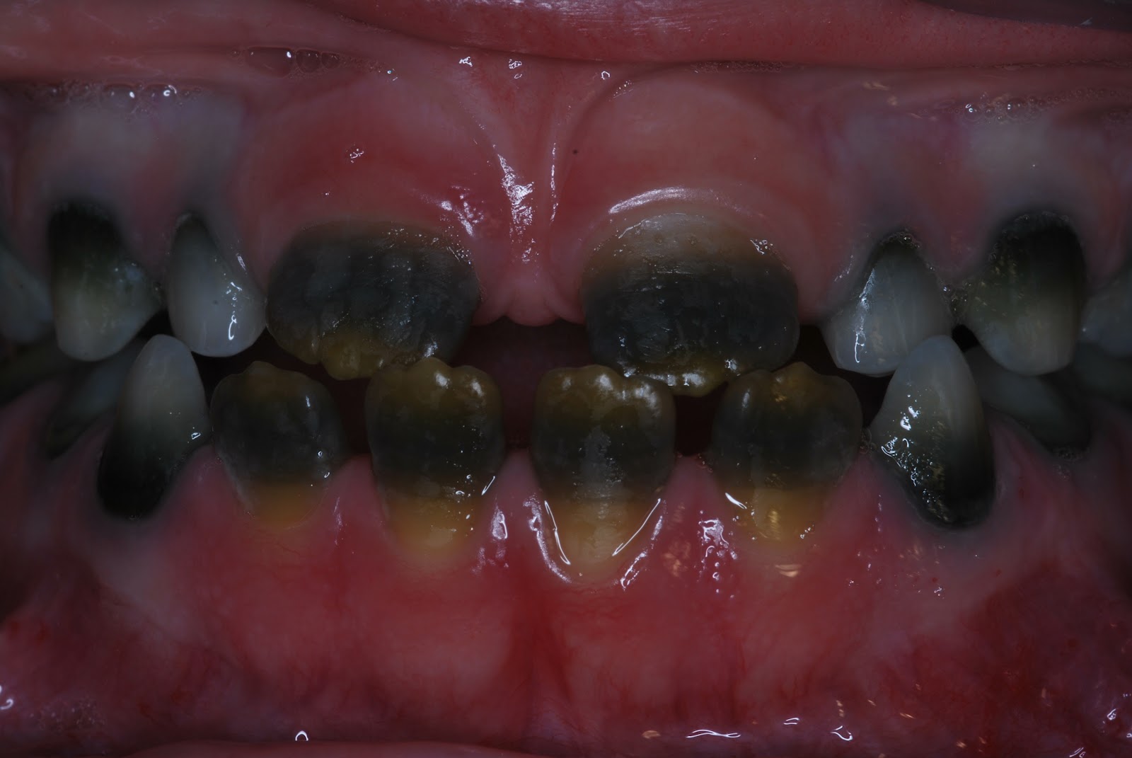 Peter's Progress Peter's gray and brown striped teeth