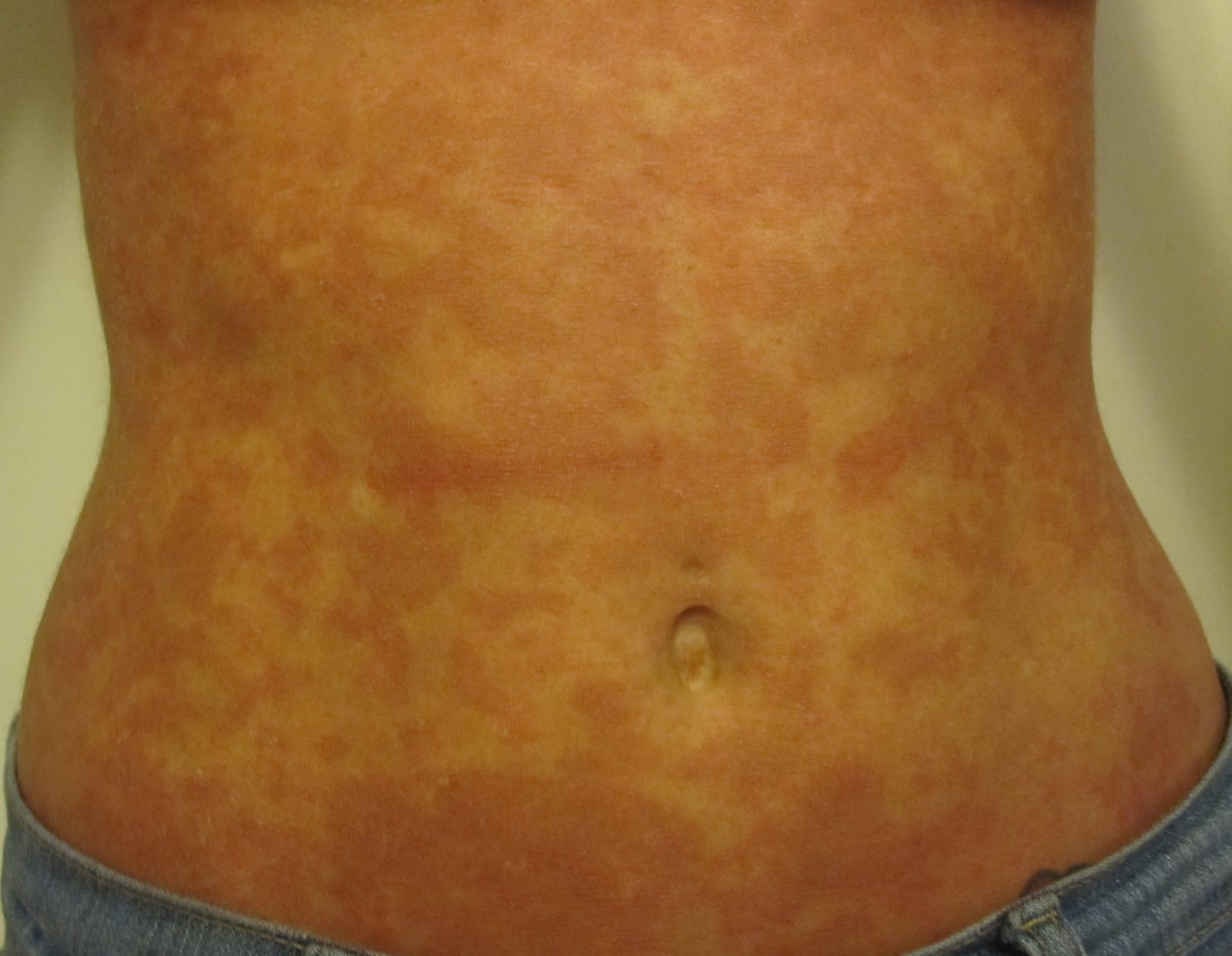 small-red-spots-on-chest-and-stomach-not-itchy-small-lump-on-cat-s