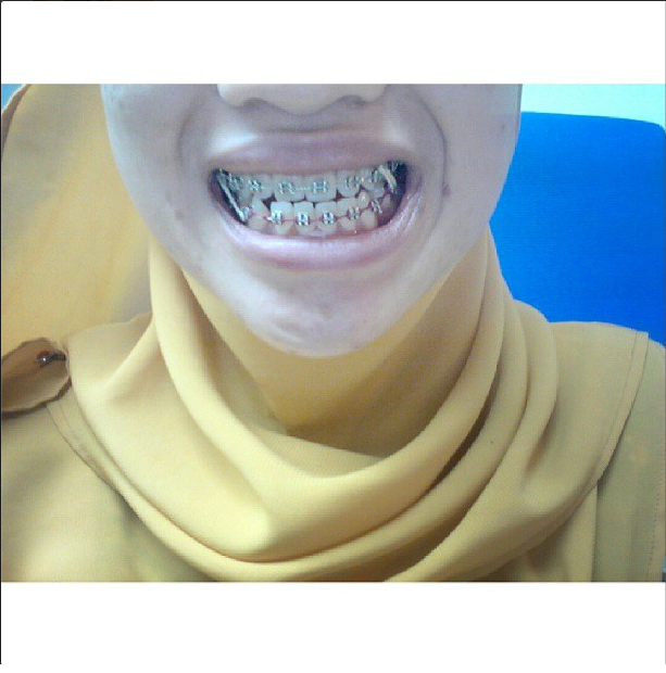 IzanSalleh Braces Progress, Bulan keberapa entah. Warna Warni.