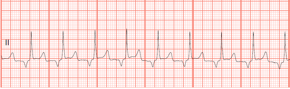 Float Nurse: Basic EKG Test 52