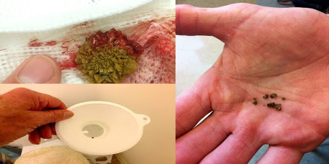 कैसा भी स्टोन हो चाहे किडनी में चाहे Gall Bladder में चाहे पेशाब की नाली में – ये इस्तेमाल करो और फिर बताओ. कैसा भी स्टोन हो चाहे किडनी में चाहे Gall Bladder में चाहे पेशाब की नाली में – ये इस्तेमाल करो और फिर बताओ.