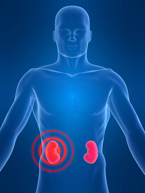 TU SALUD Y LA NUTRICIÓN.: INSUFICIENCIA RENAL CRÓNICA (IRC)