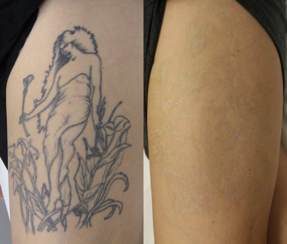 Natural Tattoo Removal: Dermabrasion Tattoo Removal - The Fact