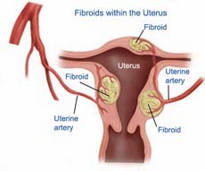 http://www.mannatfertility.com/Myomectomy.php