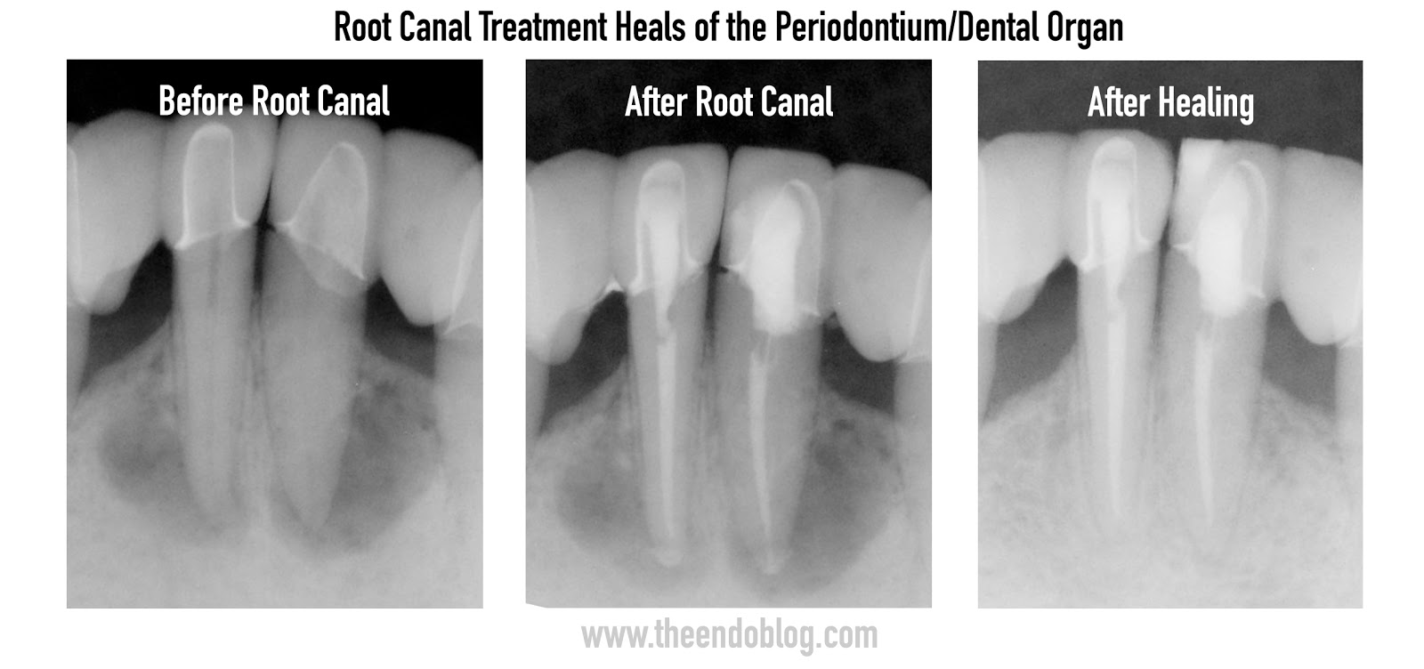 The Endo Blog "The Root Cause" Netflix Documentary & Psuedoscience A