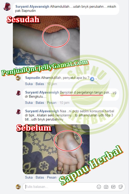 Cara Menyembuhkan Benjolan Di Belakang Lutut Tanpa Operasi Cara Menyembuhkan Benjolan Di Belakang Lutut Tanpa Operasi