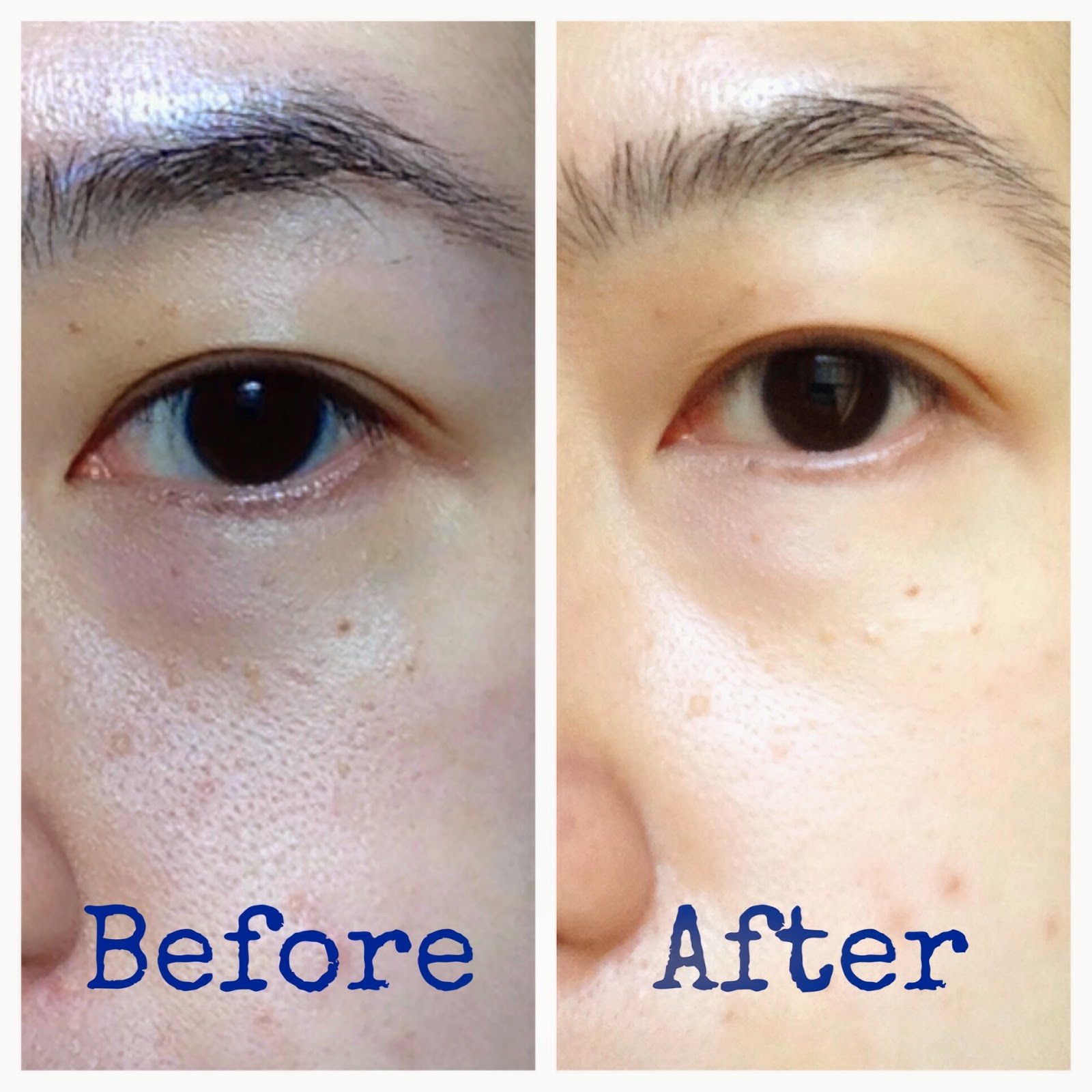 REN Resurfacing AHA Concentrate Resurfacing my face!